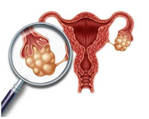 泰国可以供卵医院,泰国试管取卵之后腹水怎么办?