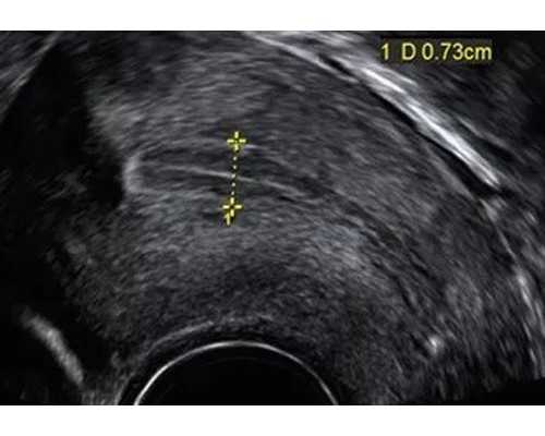 b超胎儿偏小怎么办,b超胎儿体重准吗